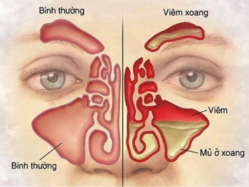 viem-xoang